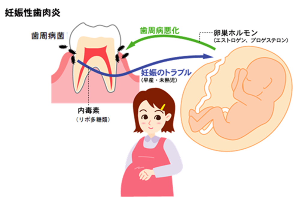 歯みがきしてもむし歯になるのはなぜ？