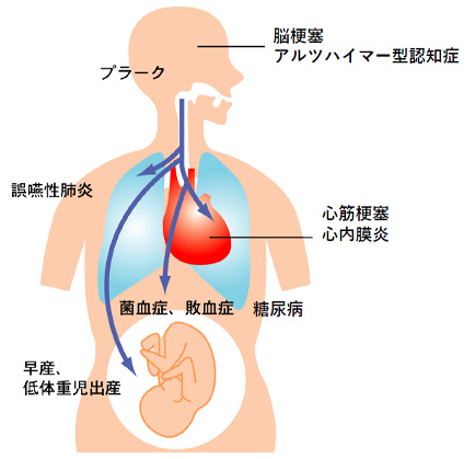 世界で一番患者の多い感染症はなに？