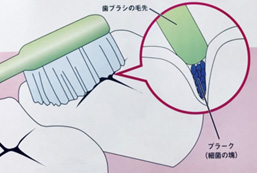 歯みがきしてもむし歯になるのはなぜ？