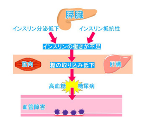 糖尿病とは